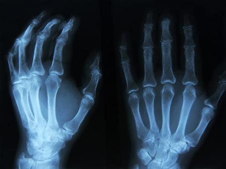 X-ray image of a patient’s left hand. The oldest image in the history of medical diagnostics is the 2D image of a hand’s interior structure. (Source: © Tsiumpa / stock.adobe.com)