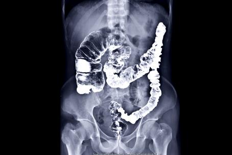 Colon X-ray image made using a contrast medium with high capability of X-ray radiation absorption. (Source: © samunella / stock.adobe.com)