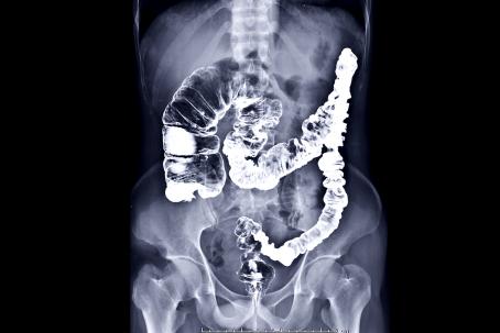 Colon X-ray image made using a contrast medium with high capability of X-ray radiation absorption. (Source: © samunella / stock.adobe.com)
