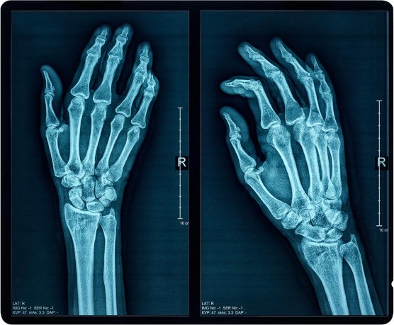 X-ray scan of human hand. (Source: &copy; PhotoEdit / stock.adobe.com)